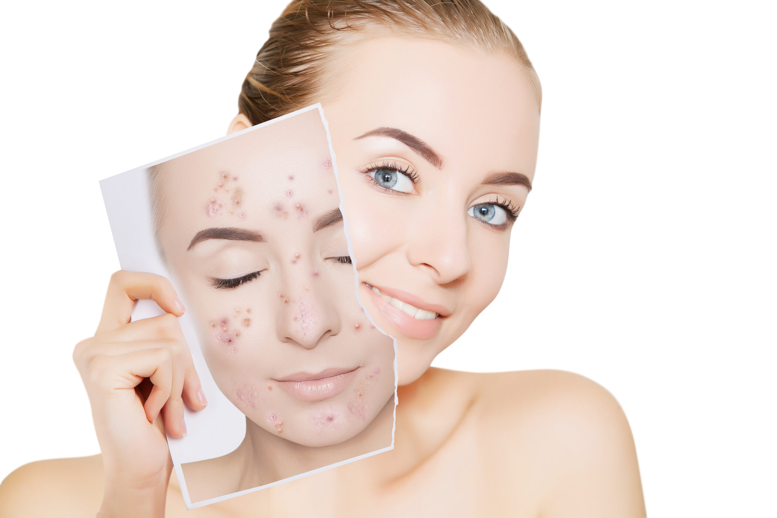 laser treatment for acne, SkinOne, Vancouver BC