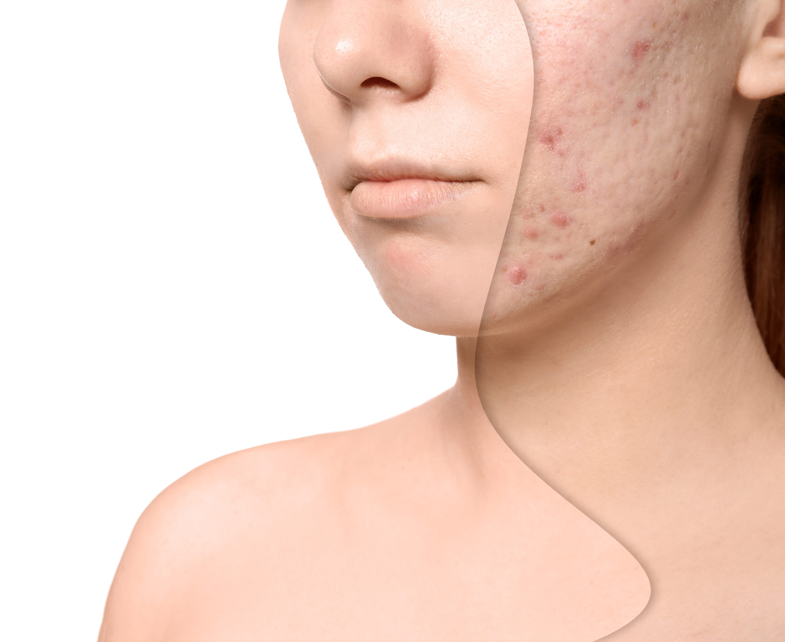 laser treatment for acne, SkinOne, Vancouver BC