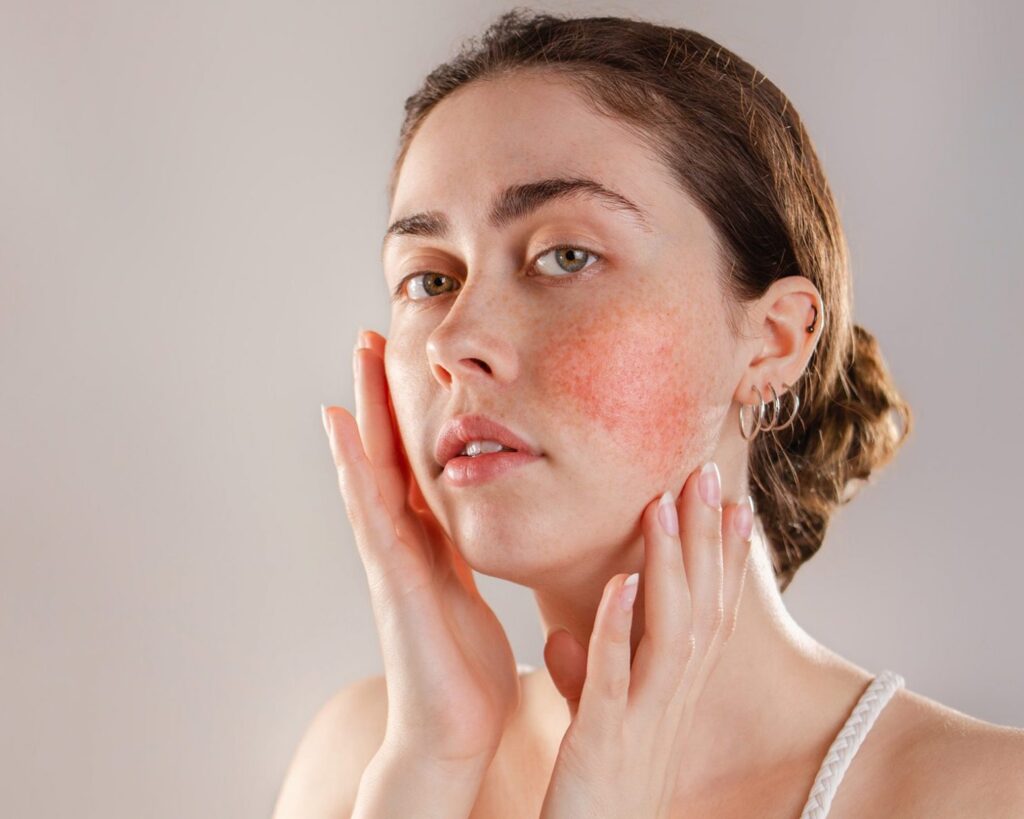 Rosacea and redness, medical aesthetics, SkinOne, Vancouver BC