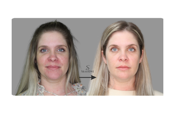 Treatment Results: Hyperpigmentation and Sun Damage: Causes, Prevention, and Treatment Options at SkinONE in West Vancouver